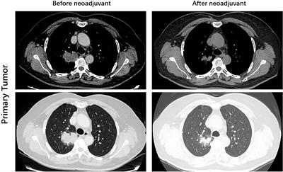 Use of savolitinib as neoadjuvant therapy for non–small cell lung cancer patient with MET exon 14 skipping alterations: A case report
